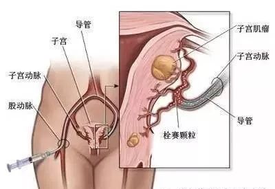 子宫肌瘤治疗前沿技术探索与进展